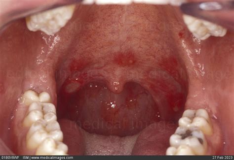 Stock Image Close Up Of The Pharynx Showing Herpetic Pharyngitis An