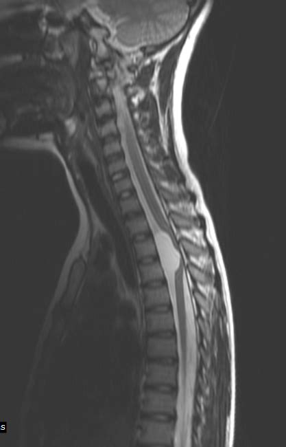 Spinal Intradural Arachnoid Cyst Mri Sumers Radiology Blog