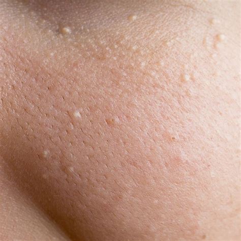 Whats That On Your Face Skin Bumps White Bumps On Face Skin Tag