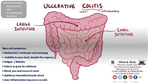 Ulcerative Colitis Mind Body Holistic Health Clinic
