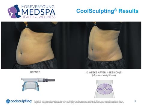 Coolsculpting Elite Liposuction Done Right Lincolnwood Il