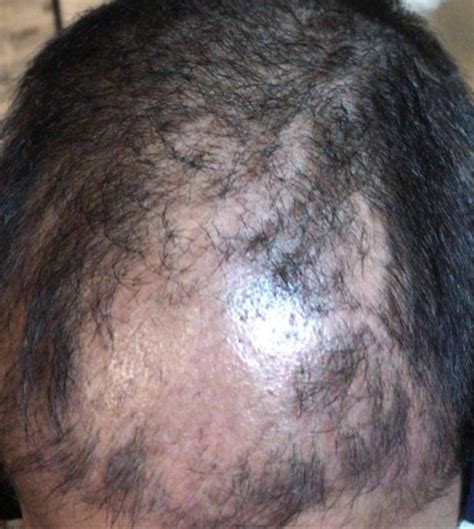 Why Does Shock Hair Loss After Hair Transplant Occur Clinicadvisor