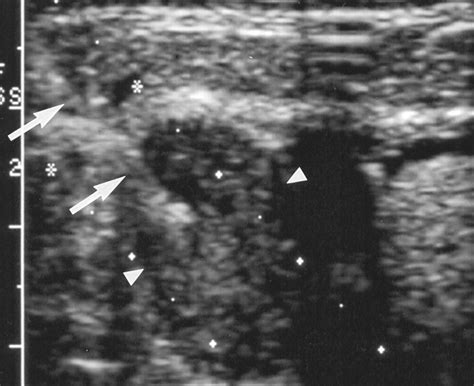 Sonographically Guided Biopsy Of Supraclavicular Lymph Nodes A Simple