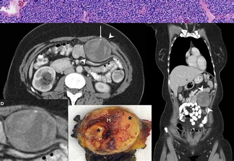 Synovial Sarcoma Of The Abdominal Wall Imaging Findings And Review Of