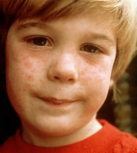 Measles Rash Pictures Symptoms Causes Treatment
