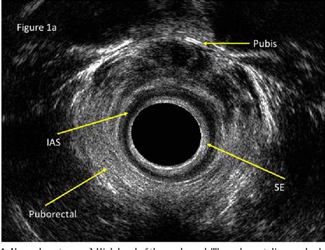 Figure 1 From Endoanal Ultrasound For Anorectal Diseases Semantic Scholar