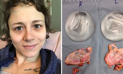 Mum Has Breast Implants Removed After Believing They Were Poisoning Her