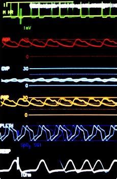 A generic term indicating the volume of air exhaled under forced conditions in the first t seconds. Vital Signs - procedure, blood, adults, time, heart ...