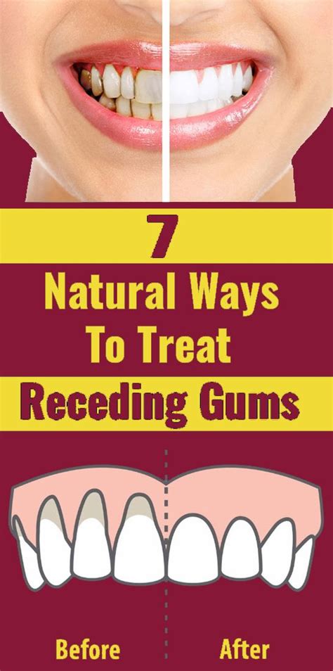 How To Keep Gums Healthy 7 Ways Receding Gums Gum Health Teeth Health