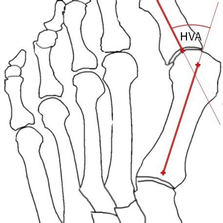 Pdf Measuring The Angle Of Hallux Valgus Using Segmentation Of Bones On X Ray Images