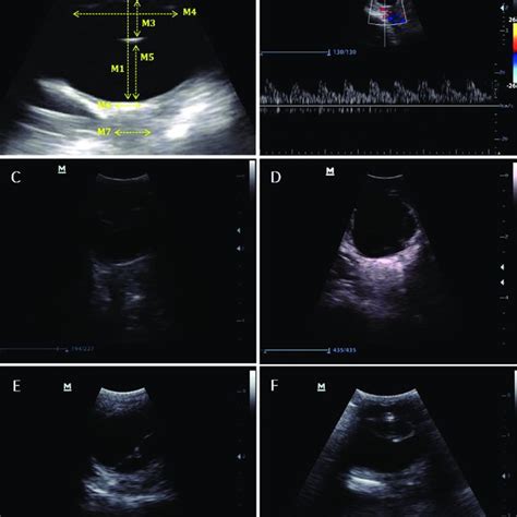 B Mode And Doppler Images Of Ultrasound Evaluation Of Healthy And With