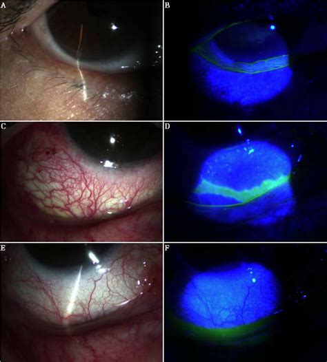 A B Preoperative Appearance Showed The Redundant Conjunctival Tissue