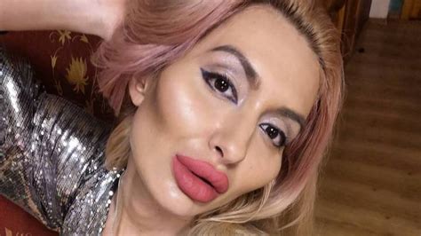 Woman With Worlds Biggest Cheeks Wants More Surgery