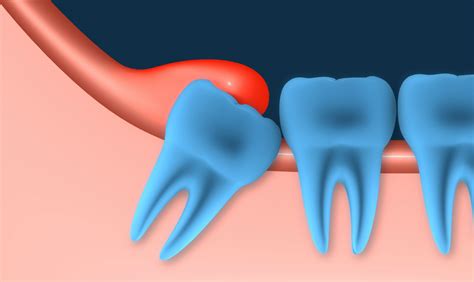 How To Get Rid Of Swollen Gums Wisdom Teeth Teethwalls