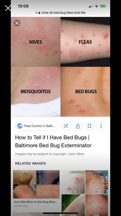 Bed Bug Bites Pictures On Hand