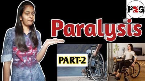 paralysis paralysis in hindi pathophysiology sign and symptoms dignosis management of