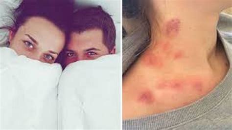 Awesome Ways To Rid Of Love Bites Naturally And Quikly Youtube