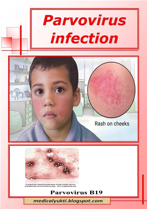 Parvovirus Infection Medical Yukti