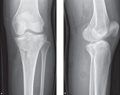 figure 1 from a posteromedial approach for open reduction and internal fixation of posteromedial