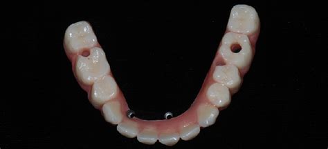 Full Dentures In Woodland Hills Biosafe Cosmetic Dentistry