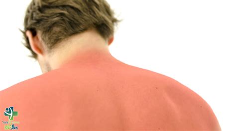 چگونه پوست آفتاب سوخته را سفید کنیم درمان آفتاب سوختگی مجله یارا فارما