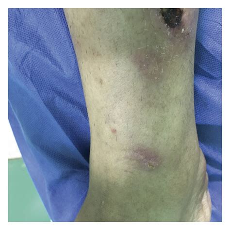 A To D Large Warm Erythematous Nontender Plaques And Subcutaneous