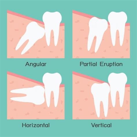 Wisdom Tooth 9 Warning Signs You Should Know To Have It Removed De