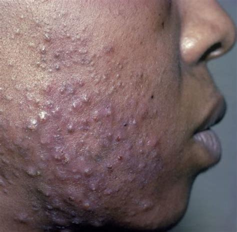 Acne Scars On Black Skin