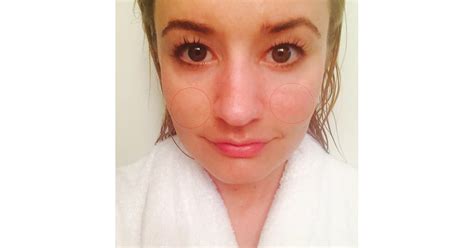 After Shower Selfie Melasma Treatment Popsugar Beauty Uk Photo 2