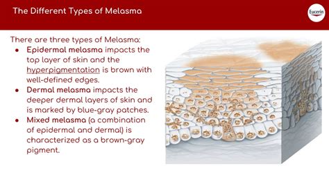 Ppt The Comprehensive Guide To Get Rid Of Melasma Powerpoint