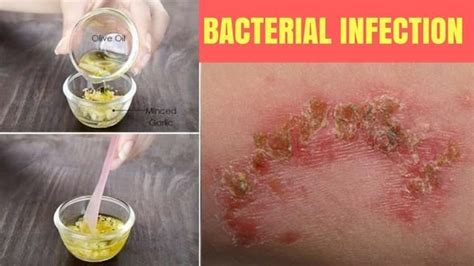How To Get Rid Of A Bacterial Infection Naturally On Your Face Without