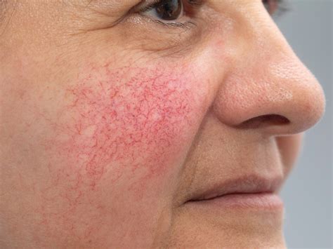 What Happens If Rosacea Is Left Untreated Balmonds
