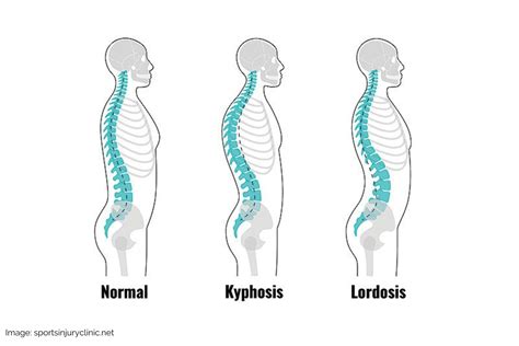 How To Fix Lordosis Doctor Recommended Lordosis Treatment Backembrace