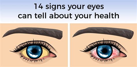 14 Eye Diseases