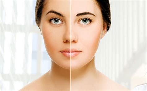 Skin Whitening Treatment Attain A Flawless Complexion Without Any