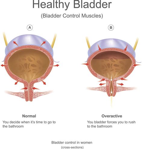 What Causes Bladder Leakage Types And Causes Of Urinary Incontinence Proof