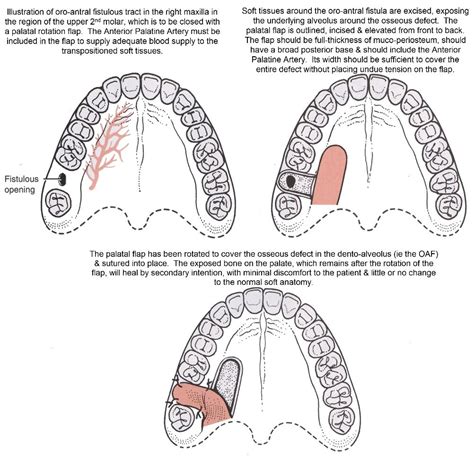 Closure Of Mouth Sinus Holes Exodontia