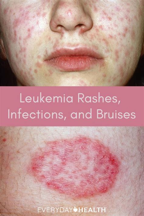 At first, it may just seem like the flu. Leukemia Rash Pictures, Signs, and Symptoms | Leukemia ...