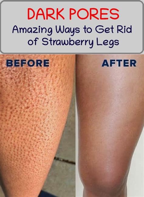 How To Finally Get Rid Of Strawberry Legs In 2020 Strawberry Legs