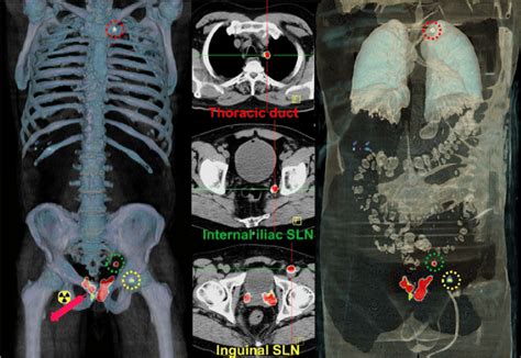 Volume Rendered Pet Ct Left And Right And Axial Pet Cts Middle