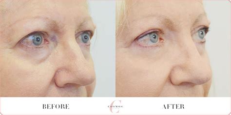 Non Surgical Eyelid Lift Before And After Cosmos Aesthetics