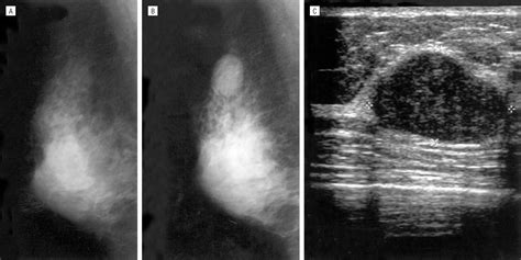 Diagnosis And Treatment Of Breast Fibroadenomas By Ultrasound Guided