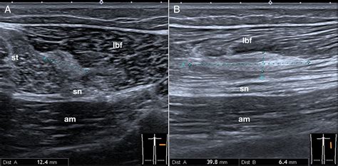 Hamstring Muscles Ultrasound