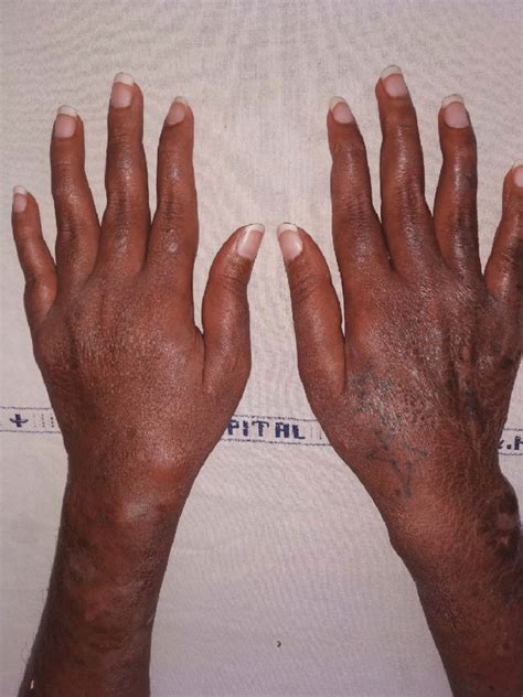 Active Lesions Of Enl On Dorsal Aspect Of Hands And Forearms Also Note