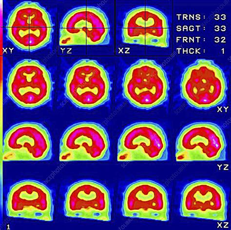 Healthy Brain Spect Scans Stock Image P3320424 Science Photo