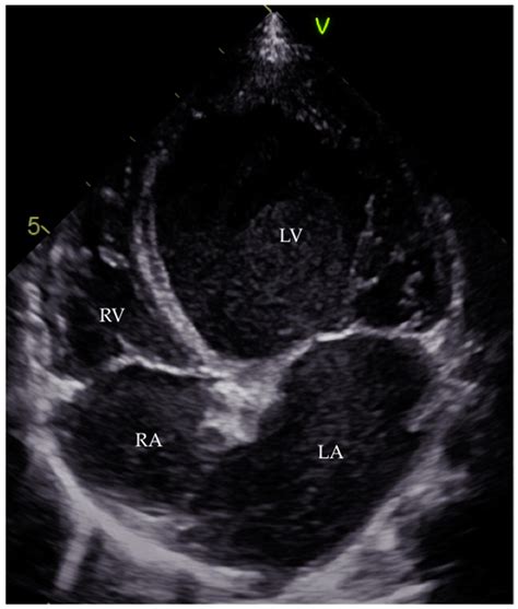 Myocarditis is an inflammatory disease of the myocardium that may present with sudden cardiac death, symptoms mimicking myocardial infarction, heart rhythm and conduction disorders, and heart failure. JCDD | Free Full-Text | Myocarditis in Paediatric Patients ...