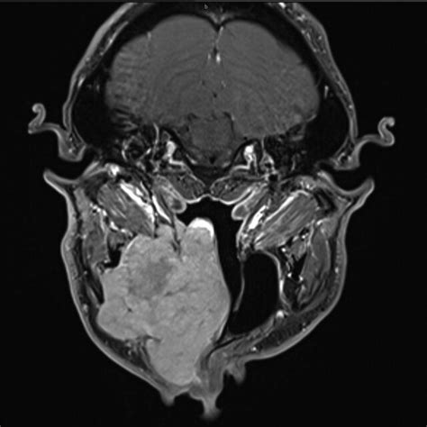 Preoperative Magnetic Resonance Imaging Mri Axial View T1 Weighted