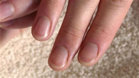 Was bedeuten weiße Flecken auf den Fingernägeln