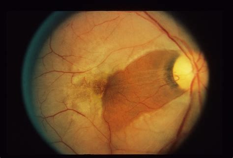 Temporary Vision Loss Retina Image Bank