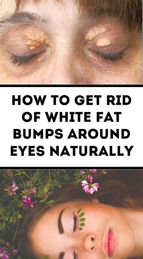 The Tiny White Bumps On Your Skin Which Normally Appear Around Your
